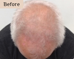 injections for hair loss treatment - before and after results